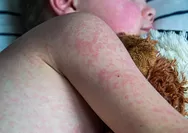 KLB Campak Melonjak, Kemenkes Terbitkan SE Wajibkan Nakes Tingkatkan Kewaspadaan