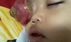 Karina Putri, Pejuang Kecil Melawan Kanker Mata, Butuh Uluran Tangan