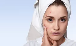 8 Cara Sederhana Menghilangkan Jerawat di Alis Secara Alami