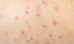 Kenali Jamur yang Sering Ada di Paha Dalam, Ini Penyebab dan Cara Mengobati