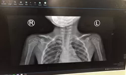 Pengalaman Merawat Anak Balita Mengalami Patah Tulang Selangka, Orang tua Bisa Lakukan Ini