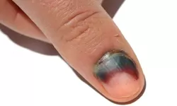 Cara Mengatasi Darah Beku di Kuku Tangan dan Kaki, Simak Juga Penyebabnya!