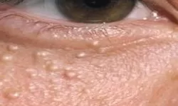 Milia Atau Bintik Susu: Apa Itu, Penyebabnya Hingga Penanganannya!