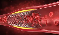 9 Tanda Ini Sering Diabaikan Namun Bisa Jadi Gejala Pembuluh Darah Anda Tersumbat Lho!