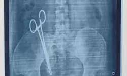 Gunting Bedah Bersarang Dalam Perut Wanita Ini Selama 17Tahun!