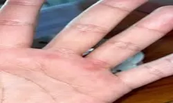 Tangan Kapalan? Ini Dia Solusinya!