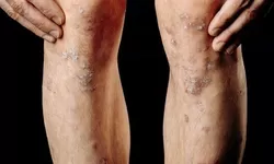 Benarkah Banyak Anak di Asrama Atau Pondok Pesantren yang Terkena Scabies? Ini Penjelasannya