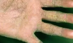 Skabies Itu Menular Lewat Apa Saja? Ini Cara Penularannya yang Jarang Disadari