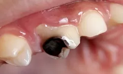 Waspadai Penyebab Karies Gigi pada Anak Sejak Dini