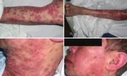 Mengenal Stevens-Johnson Syndrome: Ketika Alergi Obat Menjadi Ancaman Serius