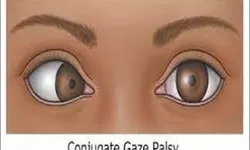Ciri-Ciri Conjugate Gaze Palsy yang Perlu Dikenali