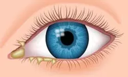 Mengenal Warna Kotoran Mata dan Artinya bagi Kesehatan