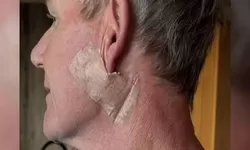 Gordon Ramsay Jalani Perawatan Kanker Kulit: Peringatan Penting soal Bahaya Sinar Matahari