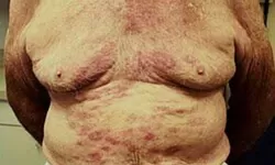 Kusta: Penyakit Infeksi Kronis yang Masih Menjadi Tantangan Kesehatan Dunia