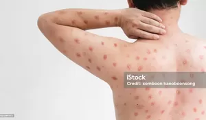 Kasus Cacar Monyet Meningkat, Pemerintah Didesak Gencarkan Vaksinasi