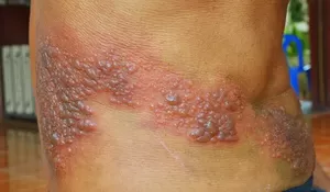Herpes, Penyebab, Gejala dan Pengobatan