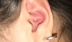 Begini Cara Mengatasi dan Mencegah Munculnya Jerawat di Telinga