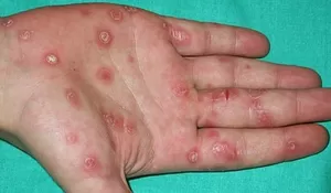 Emanuel Melkiades: Penyakit Menular Seksual HIV dan Sifilis Jangan Dianggap Tabu