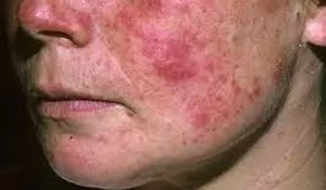 Tahukah Kamu Penyakit Lupus dan Bahayanya?