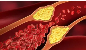 Bagi Kamu yang Punya Kolesterol Tinggi, Baca Artikel ini!