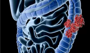 5 Kebiasaan Ini Ternyata Bisa Meningkatkan Risiko Kanker Usus Besar, Penyakit yang Diderita Nurul Qomar hingga Meninggal Dunia 