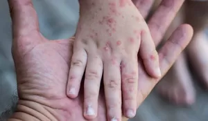 Kota Bekasi Pastikan 1 Orang Warga Positif Cacar Monyet, Dinkes : Diisolasi di RS