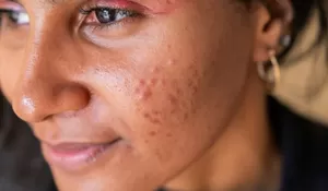 Biar Jerawat Nggak Bandel, Begini Cara Tepat Memilih Sunscreen untuk Kulit Berminyak!