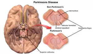 Parkinson Bukan Akhir Segalanya, Teknologi Otak Kini Buka Harapan Baru