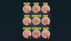 Cara Mengenali Gigitan Serangga dari Bekas di Kulit, Ini Perbedaan Nyamuk, Semut, hingga Kalajengking