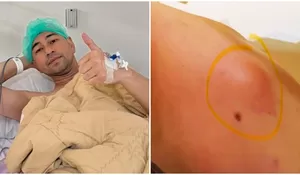 Berkaca dari Raffi Ahmad, Kenali Gejala Lipoma atau Tumor Jinak yang Berawal dari Benjolan Kecil, Kapan Harus Segera Dioperasi?