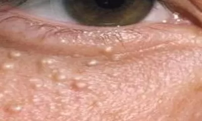 Milia Atau Bintik Susu: Apa Itu, Penyebabnya Hingga Penanganannya!