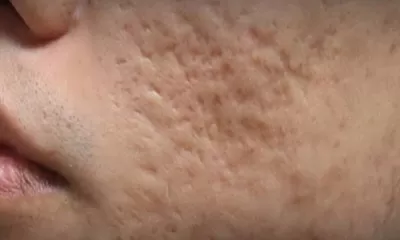 Doktif Jawab Nyinyiran Bopeng di Wajahnya karena Rawat Pasien COVID-19, Begini Alur Penyebabnya