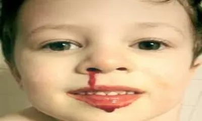 Begini Cara Pertolongan Pertama yang Benar Saat Terjadi Mimisan