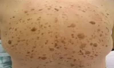 Mengenal Gejala Seratosis Seboroik Hingga Penanganannya!
