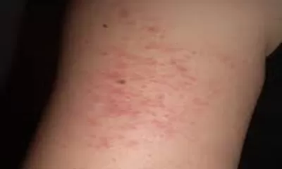 Mengenal Gejala Keratosis Pilaris Hingga Penangannya!