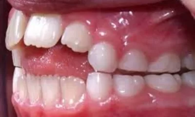 Bahaya Isap Jari Pada Anak, Dampaknya Terhadap Kesehatan Gigi dan Mulut