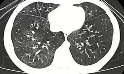 Mengenal Apa Itu Popcorn Lung: Gejala Hingga Penanganannya