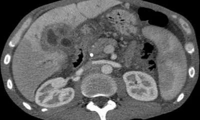 Gejala, Tanda Awal, dan Penanganan pada Kanker Hati: Waspadai Isyarat yang Sering Diabaikan