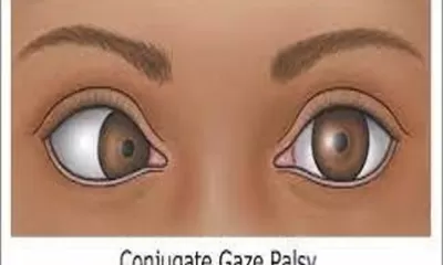 Conjugate Gaze Palsy: Penyebab dan Dampaknya bagi Pasien