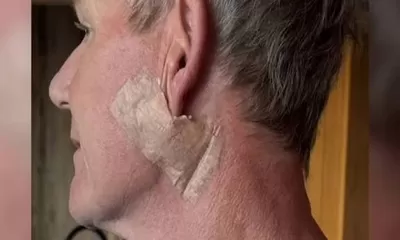 Gordon Ramsay Jalani Perawatan Kanker Kulit: Peringatan Penting soal Bahaya Sinar Matahari