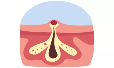 Apa Itu Folikulitis dan Bagaimana Membedakannya dari Ingrown Hair?