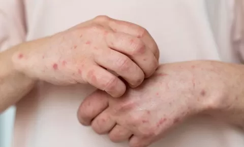 Wajib Tahu Apa Saja Jenis-Jenis Penyakit Kulit yang Dapat Menyerang Tubuh