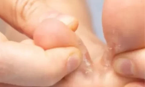 Alami Kutu Air? Wajib Tahu Penyakit Ini Disebabkan Oleh Apa