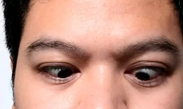  Gejala Mata Juling alias Strabismus, Apa Penyebab dan Bagaimana Cara Menanganinya?