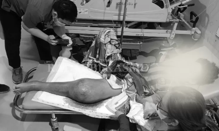 Miris, Siswa SD di Bekasi yang Terpaksa Diamputasi Kakinya Usai Disliding Temannya Menderita Kanker Stadium 4