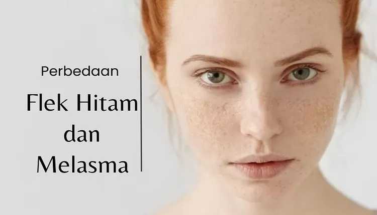 Penyakit Kulit Melasma Kenapa Sering Dialami Oleh Wanita Ketimbang Pria ...