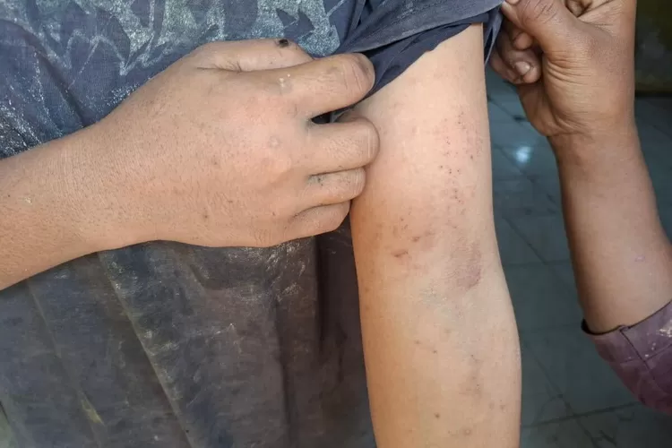 Seorang remaja, menunjukkan bintik merah pada lengannya. Gatal-gatal setelah mandi dengan air tercampur FABA. (f: Mongabay Indonesia)