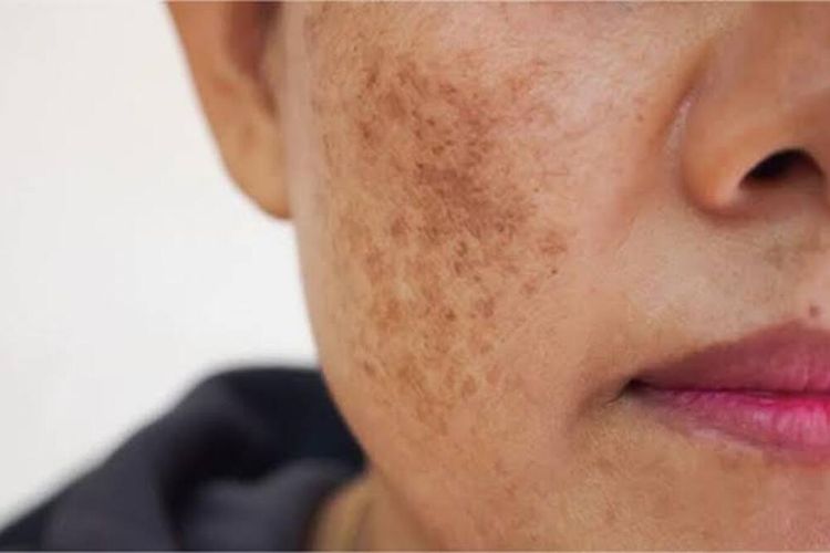 Cara Menghilangkan Flek Hitam di Wajah dengan Bahan Alami