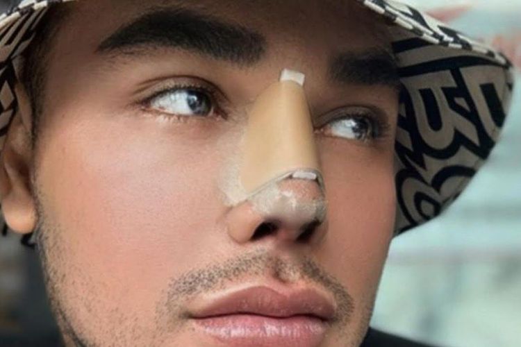 Transformasi Drastis! 7 Selebriti Indonesia yang Pernah Operasi Hidung