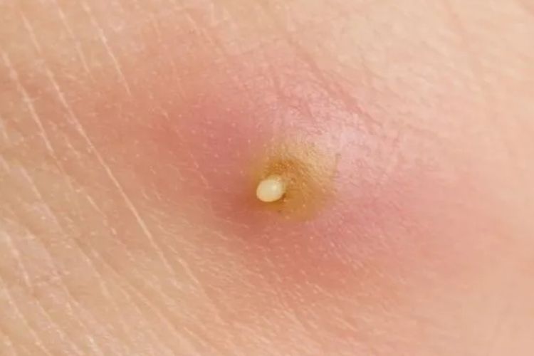 Jangan Panik! Ini 5 Cara Ampuh Obati Bisul di Rumah